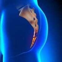 Coccyx or Tailbone Pain Treatment In Delhi and Gurgaon